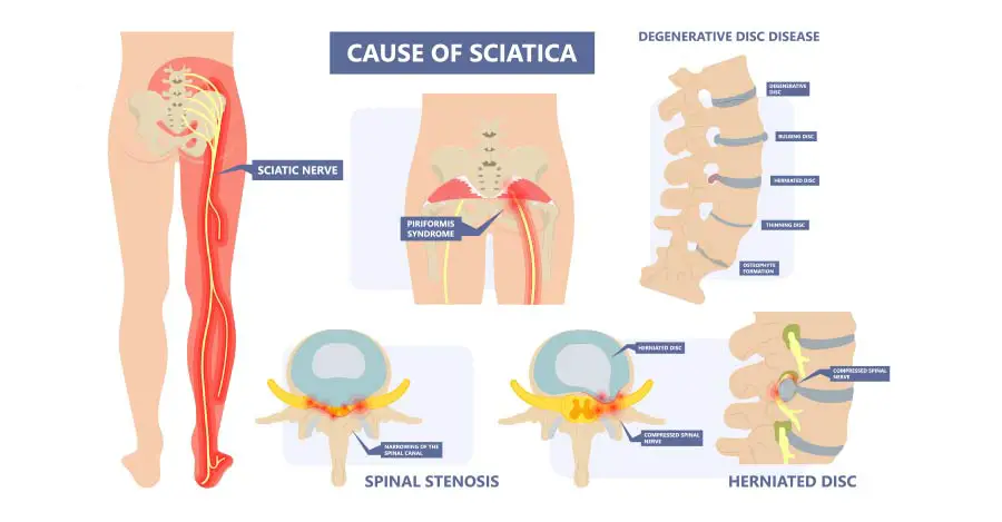 worldcrutches-cause of Sciatica