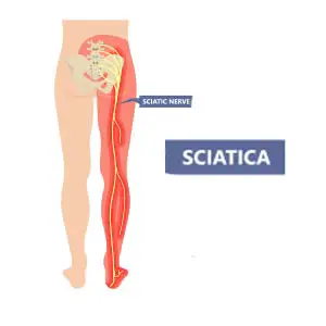 worldcrutches-what-is-Sciatica