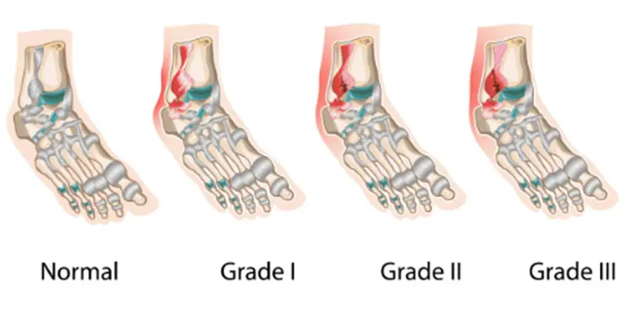 worldcrutches-The-Three-Grade-Classifications-Of-A-Sprained-Ankle