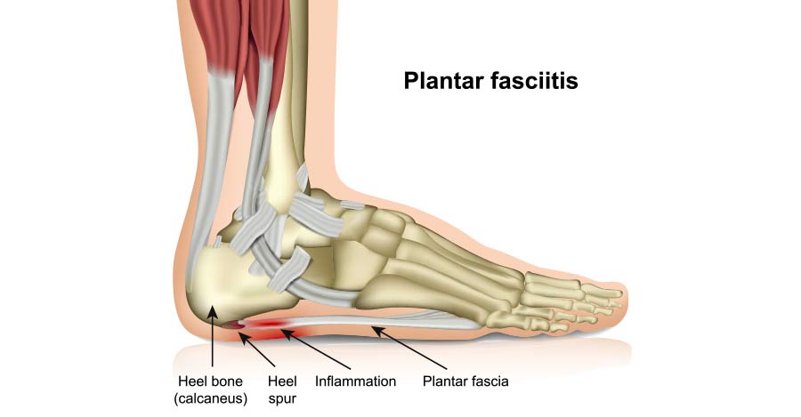 worldcrutches-What is Plantar-Fasciitis