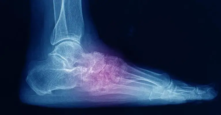 Lisfranc Injury: Surgery, Treatment & Recovery Time