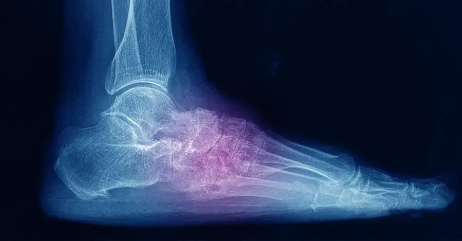 worldcrutches-What-Is-A-Lisfranc-Foot-Injury