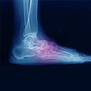 worldcrutches-The-Diagnosis-Of-A-Lisfranc-Foot-Injury