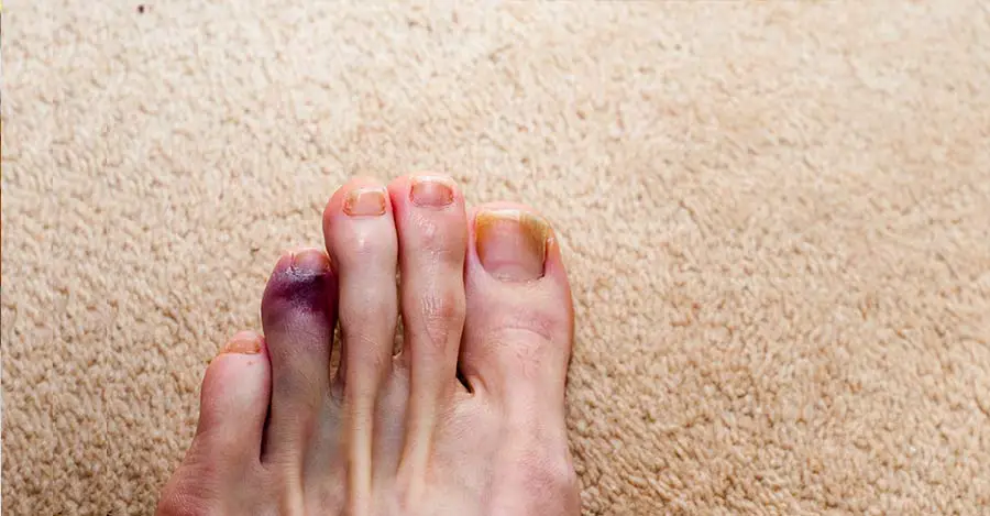 worldcrutches-skin-on-your-toe-is-bruising