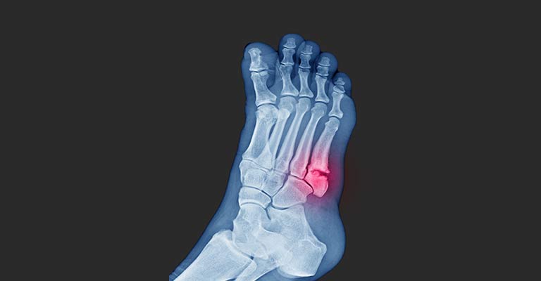 worldcrutches-Jones-Fracture